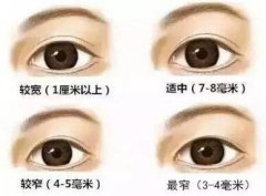 全切双眼皮6mm7mm8mm图对比!美目日记分享,附3家口碑高分医院~ 全切双眼皮6mm7mm8mm图对比!美目日记分享,附3家口碑高分医院~