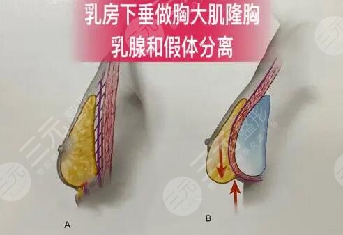 法国ES隆胸假体