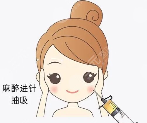 面部吸脂做完10天图片