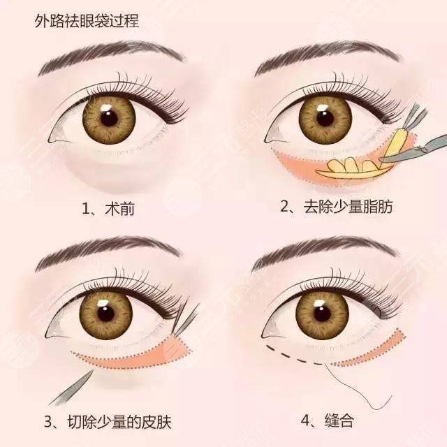 上海美诗沁医疗美容诊所去眼袋案例分享