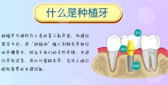 全口种植牙种几颗？2种不同技术介绍！附价格表+口腔医院3家~