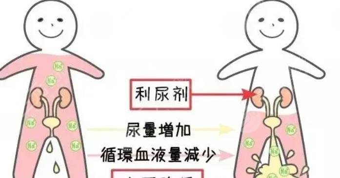 利尿剂