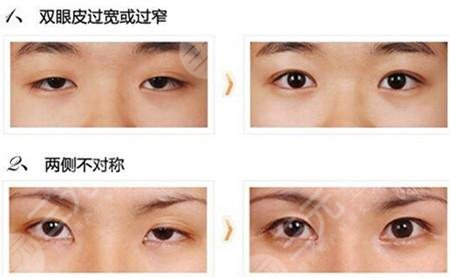 双眼皮失败的八种图片展示|常见的5种
