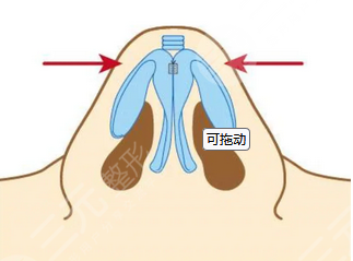 北京大学深圳医院隆鼻案例分享