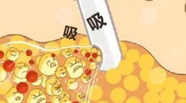 郑州人民医院整形科吸脂瘦身案例分享