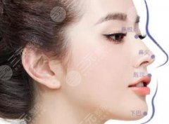 北京大学深圳医院隆鼻怎么样?多少钱?人气医生实力抢先看!附费用明细 北京大学深圳医院隆鼻怎么样?多少钱?人气医生实力抢先看!附费用明细