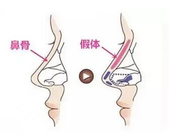北京大学深圳医院隆鼻案例分享