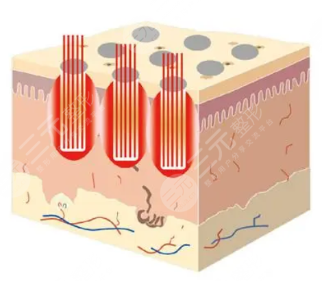 河北省二院点阵激光挂哪个科