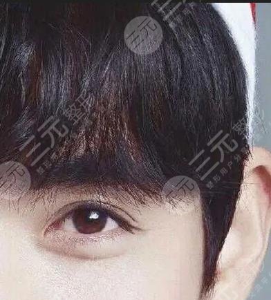 中大医院割双眼皮案例分享