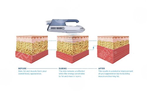 美修斯减肥有用吗?