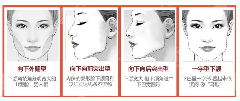 赵延峰做下颌角案例
