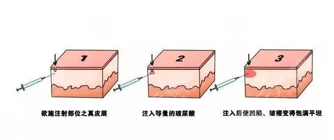 玻尿酸填充法令纹多少钱