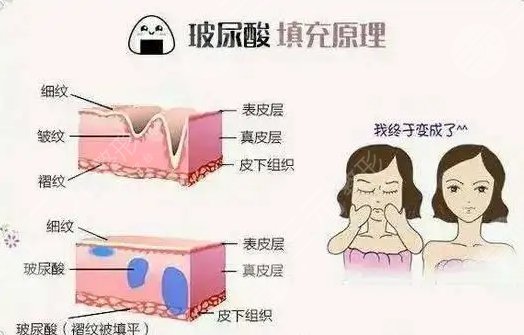 玻尿酸填充法令纹多少钱