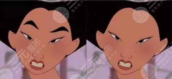 激光洗眉后1至7天的变化图贴出，短短一周能恢复到什么程度？果吗？