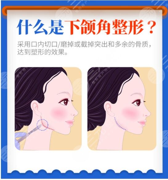 下颌角长曲线截骨项目科普