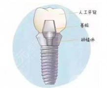 石家庄种植牙价格表2023大全！附2家正规口腔医院介绍，必备指南~