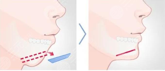 女人后缩下颌角整形优势