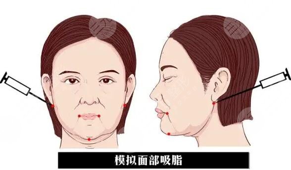面颊吸脂要戴多久的头套?