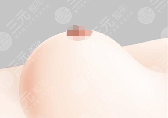 娜高丰胸假体好不好