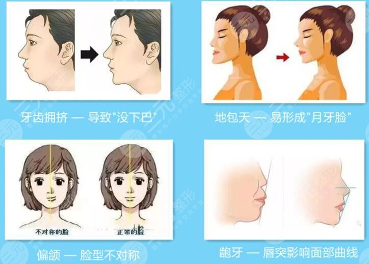 改脸型手术的副作用