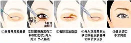 去眼袋手术恢复时间有多长呢?