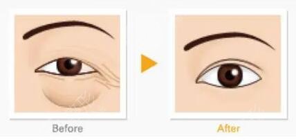 去眼袋手术的费用高吗?