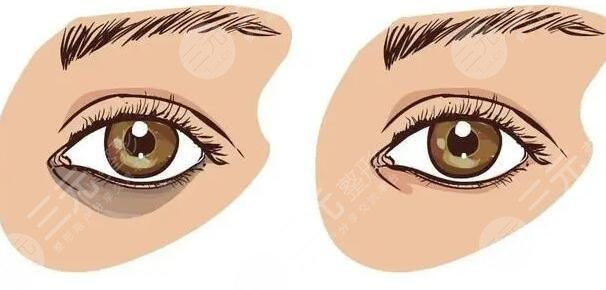 做去眼袋之后疤痕软膏多长时间可以停用?