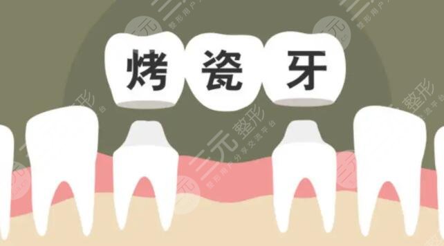 烤瓷牙多少钱一颗价格表2022全国，烤瓷牙寿命可以保持几年？收藏不亏！