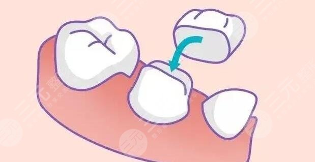 烤瓷牙多少钱一颗价格表2022