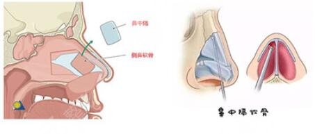 半肋骨鼻和全肋骨鼻的区别是什么？