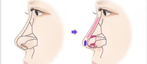 半肋骨鼻和全肋骨鼻术后注意事项