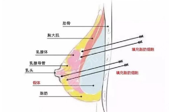 隆胸