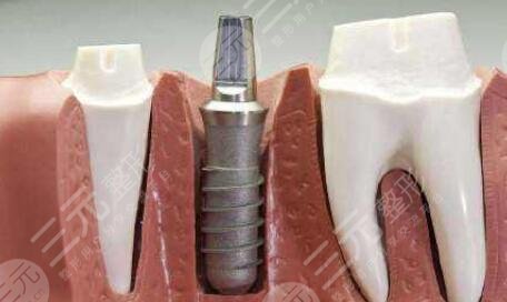 种植牙