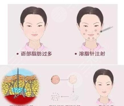 全脸脂肪填充术后注意事项