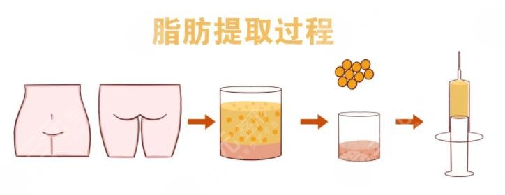 全脸脂肪填充的副作用