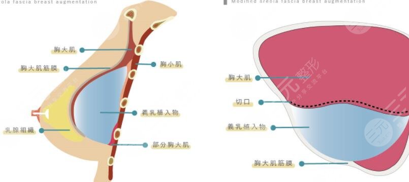 es假体隆胸果好吗？