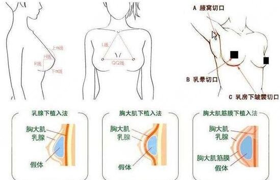 es假体隆胸注意事项