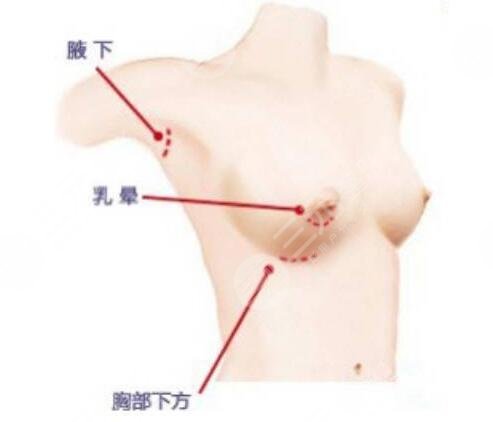 新维度丰胸多少钱?