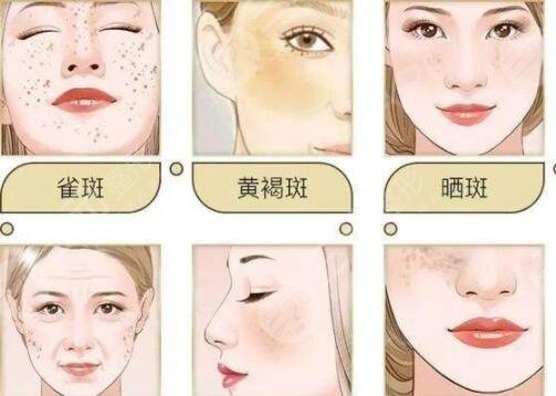 彩光祛斑的优势: