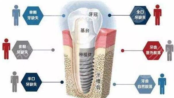 植一颗大牙多少钱一颗？