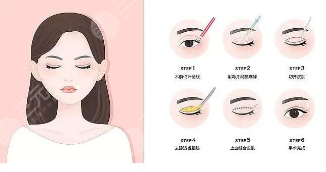 常州市第一人民医院整形烧伤科双眼皮手术整形案例