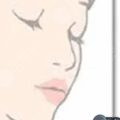 玻尿酸丰唇做一次能维持多久?