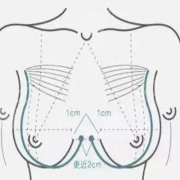 乳晕漂红做一次就行吗?果怎么样?多少钱? 乳晕漂红做一次就行吗?果怎么样?多少钱?