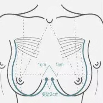 乳晕漂红做一次就行吗?果怎么样?多少钱?