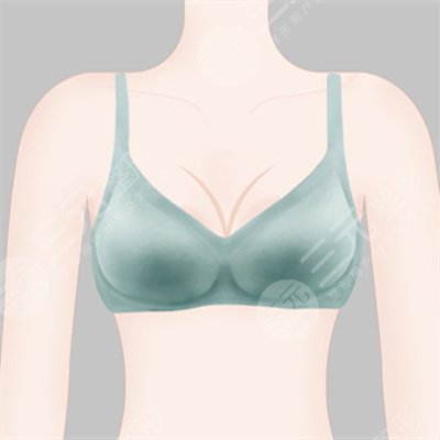 乳晕漂红做一次就行吗?果怎么样?多少钱?