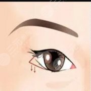 眼部吸脂有什么果,有后遗症较轻(不代表不会出现后遗症) 眼部吸脂有什么果,有后遗症较轻(不代表不会出现后遗症)