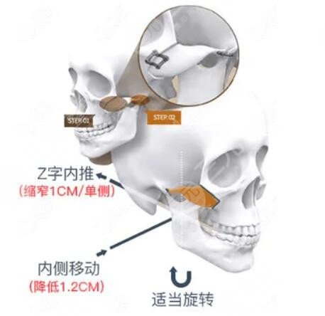 方脸磨骨术后果如何？