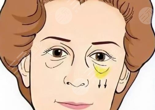 眼袋