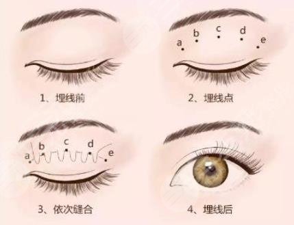 全切双眼皮案例