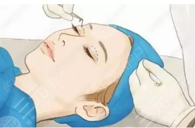 泰安附属医院美容科埋线双眼皮案例分享